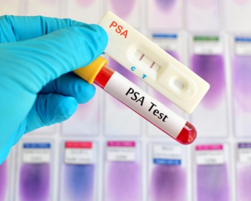 Prostate Cancer Test